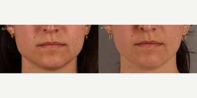 Masseter Botox for TMJ / Jawline Slimming - 27-year-old female who presented complaining that her face had become more square, corresponding to pain and tooth damage from grinding and clenching her teeth. She is shown 6 weeks after neurotoxin (Botox) treatment to these muscles, resulting in jawline slimming and a more heart-shaped face. She also has complete relief from her symptoms related to teeth grinding and clenching.