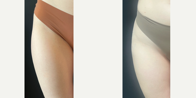 25-34 year old woman treated with Radiesse - 25-34 year old woman treated with Radiesse for hip dips.