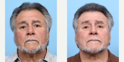 75 and up year old man treated with Eyelid Surgery - This patient was unhappy with the aging appearance of his eyes. Dr. Wise performed an upper blepharoplasty to remove the excess lax skin and tighten the area, resulting in a more youthful and refreshed appearance.