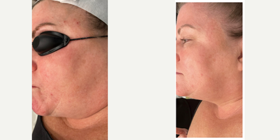 45-54 year old woman treated with CoolPeel - 4 weeks after IPL & Coolpeel