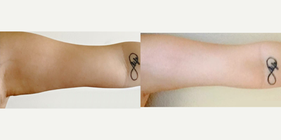 18-24 year old woman treated with Venus Freeze - Patient was treated with Venus Freeze to tighten the loose skin under her arms. The picture was taken after completing the 2nd session. Six sessions are recommended for optimal results.