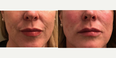45-54 year old woman treated with Injectable Fillers - This patient was injected with Belotero in her fine lines and wrinkles around the mouth. Revanesse Versa was used in the deeper lines around her mouth.