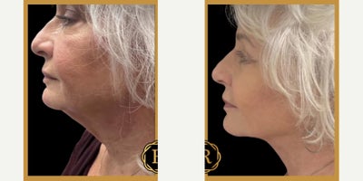 65-74 year old woman treated with Neck Lift - Procedures performed: Neck Lift