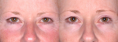 Ultherapy - 
	Ultherapy
