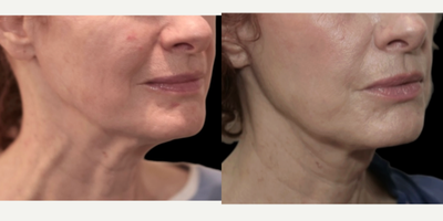 55-64 year old woman treated with MyEllevate - A 59 year old female who was complaining about her sagging neck and desired a less invasive procedure. The MyEllevate Plus procedure was performed utilizing a series of small skin punctures to place a U- shaped loop suture under the jawline to increase jawline definition. The same suture system is also utilized to divide the platysma muscle bands present on either side of the midline of the neck to further improve the contour of the neck. A skin tuck behind the ear enhances the result by removing excess skin.