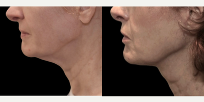 55-64 year old woman treated with MyEllevate - A 59 year old female who was complaining about her sagging neck and desired a less invasive procedure. The MyEllevate Plus procedure was performed utilizing a series of small skin punctures to place a U- shaped loop suture under the jawline to increase jawline definition. The same suture system is also utilized to divide the platysma muscle bands present on either side of the midline of the neck to further improve the contour of the neck. A skin tuck behind the ear enhances the result by removing excess skin.