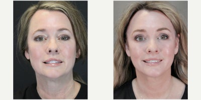 Woman treated with Eyelid Surgery, Brow Lift - Woman treated with Eyelid Surgery, Brow Lift