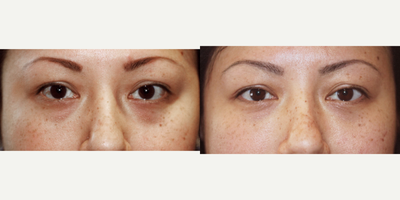 31 year old woman treated with Restylane - 31-year-old female complaining of dark circles. Restylane injected into tear troughs.