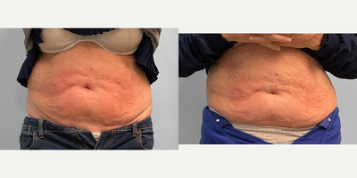 65-74 year old woman treated with Emsculpt - This woman in her late sixties was interested in toning her abdomen with Emsculpt Neo. She had four sessions over two months with our body contouring specialist Jessica and is pictured before and after.