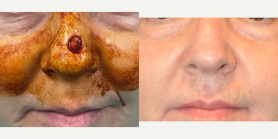 55-64 year old woman treated with Mohs Surgery - Adjacent Tissue Transfer on Nasal Dorsum.
