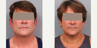 45-54 year old man treated with Chin Liposuction - This 49-year-old male patient came in stating that he just wanted to look better before his 50th birthday, but he didn't want any major surgery. His neck line was sort of poorly defined, and he liked the idea of cleaning up his profile.