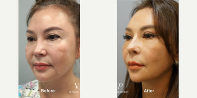 55-64 year old woman treated with Asian Rhinoplasty, Rhinoplasty, Revision Rhinoplasty, Facelift, Deep Plane Facelift, SMAS Face - 2 year post operative surgery before and after for 60-year-old female patientSurgery List:Extended deep plane faceliftNecklift, Middle neck plicationRib cartilage rhinoplasty, Mid face augmentationEndoscopic forehead & brow liftFull face fat graftingStem cell treatmentPerformed by VIP Plastic Surgery chief surgeon, Dr. Myung Ju Lee