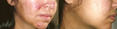 Acne Treatment with Smoothbeam - 
	Acne Treatment with Smoothbeam
