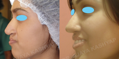 18-24 year old woman treated with Rhinoplasty, Cleft Lip And Palate Repair - 19 year old who underwent a rhinoplasty and and a cleft lip and palate repair (revision)