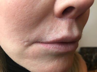 Lip Lift. Washington, DC