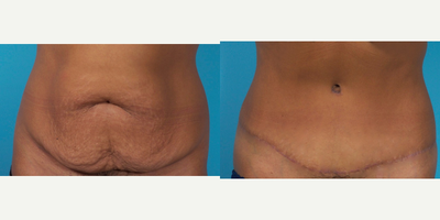 43 Year Old Woman Treated With Painless/Drainless Abdominoplasty - 5 Months Post-Op - 43 Year Old Woman Treated With Painless/Drainless Abdominoplasty - 5 Months Post-Op