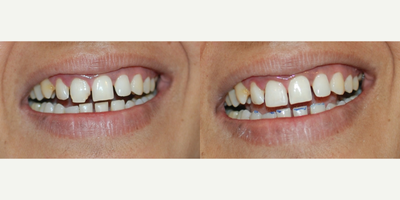 48 year old woman treated with Tooth Repair - A 48 years old woman was treated by simple bonding procedure. We were careful to do minimal preparation for restoration.