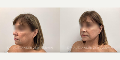 Woman treated with Facelift - Woman treated with Facelift