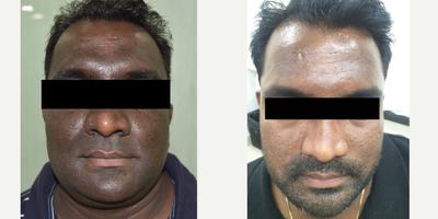 25-34 year old man treated with Skin Lightening - A 32 year old male complains of hyper pigmented facial skin. Skin lightening chemical peels done with oral antioxidants.