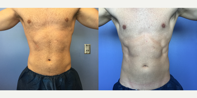 35-44 year old man treated with CoolTone - 39 year old male with 4 treatments of CoolTone to the abdomen. These before and afters were 30 days following a set of 4 CoolTone treatments