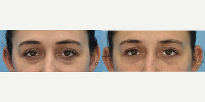 25-34 year old woman treated with Injectable Fillers - 1cc of Injectable Filler to the Under Eyes