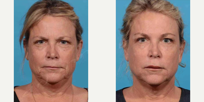 Woman treated with Liquid Facelift - Woman treated with Fat Transfer to Face and Liquid Facelift on Temples, Lower Eyelid and Cheeks, Nasolabial Folds, Marionette Lines, Chin, and Jaw.