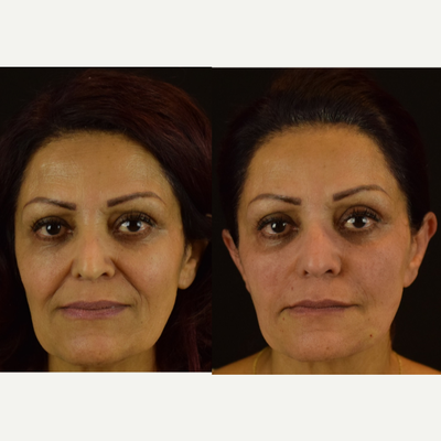 PDO NovaThreads - This patient came looking for a non-invasive, office based procedure to provide her with facial tissue lifting to improve her overall aesthetic. NovaThreads isa resorbable suture material that offers lifting of the facial tissues. Her treatment areas included the midface to enhance her cheeks and the lower 1/3 to help improve her jowls and give her that V-shape back. Results shown are before and immediate afters, thus signifying minimal to no downtime for this procedure.