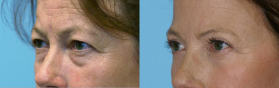 Upper and Lower Blepharolplasty - 	This patient wanted to brighten up the look of her eyes. She was not interested in a browlift. Performed an upper and lower eyelid lift to take away the sags and bags of the eyelids. The shape of the eyes do not change thereby giving a natural, refreshed result.