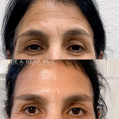 Jeuveau before and after photo