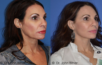 Laser Resurfacing before and after photo