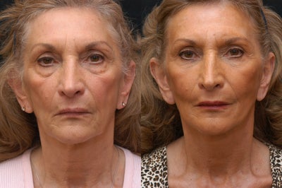 Nonsurgical Facelift before and after photo