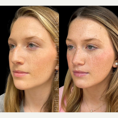 Rhinoplasty before and after photo