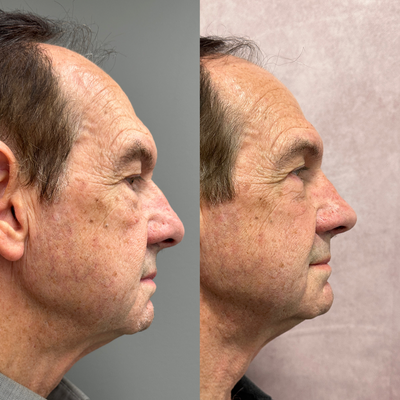Rhinoplasty before and after photo