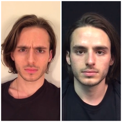 Dysport before and after photo