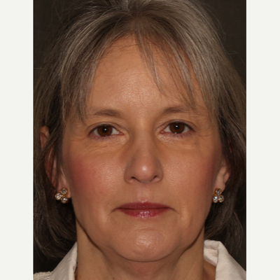 Ridenour Plastic Surgery Saint Louis Missouri Realself