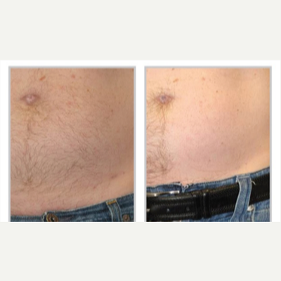 Laser Hair Removal before and after photo