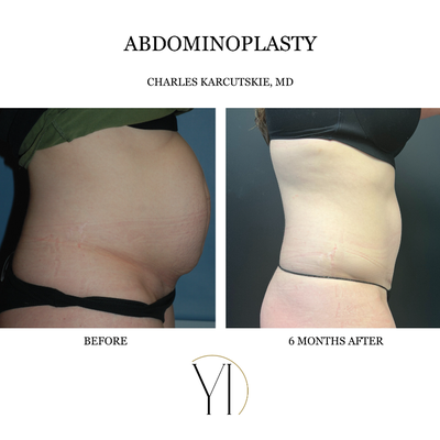 Tummy Tuck before and after photo