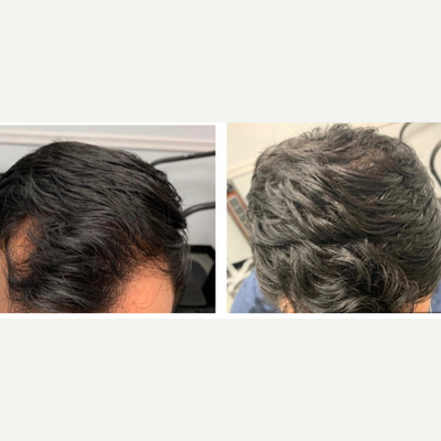 PRP for Hair Loss before and after photo