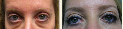 Eyelid Surgery before and after photo