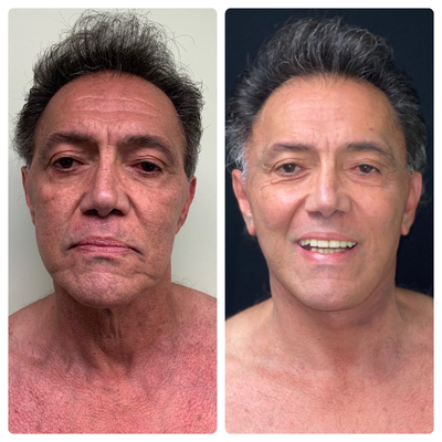 Facelift before and after photo