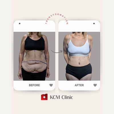 Tummy Tuck before and after photo
