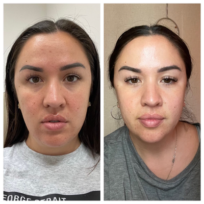 VI Peel before and after photo