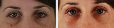 Eyelid Surgery before and after photo