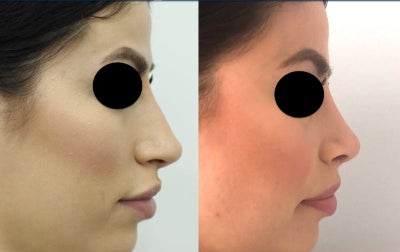 Rhinoplasty before and after photo
