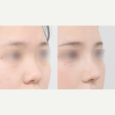 Asian Rhinoplasty before and after photo