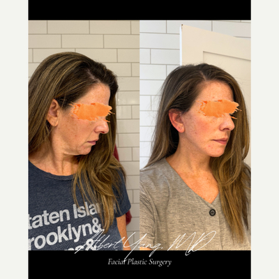 Neck Lift before and after photo