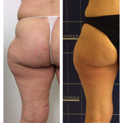 CoolSculpting before and after photo