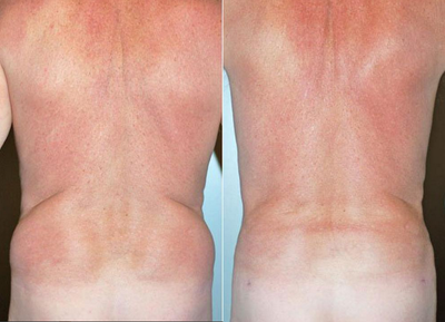 Liposuction before and after photo
