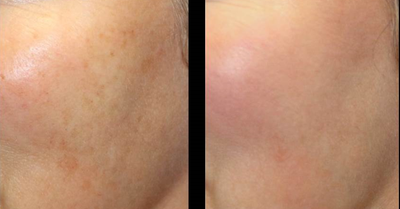 IPL before and after photo
