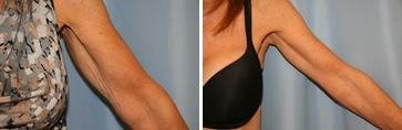 Arm Lift before and after photo